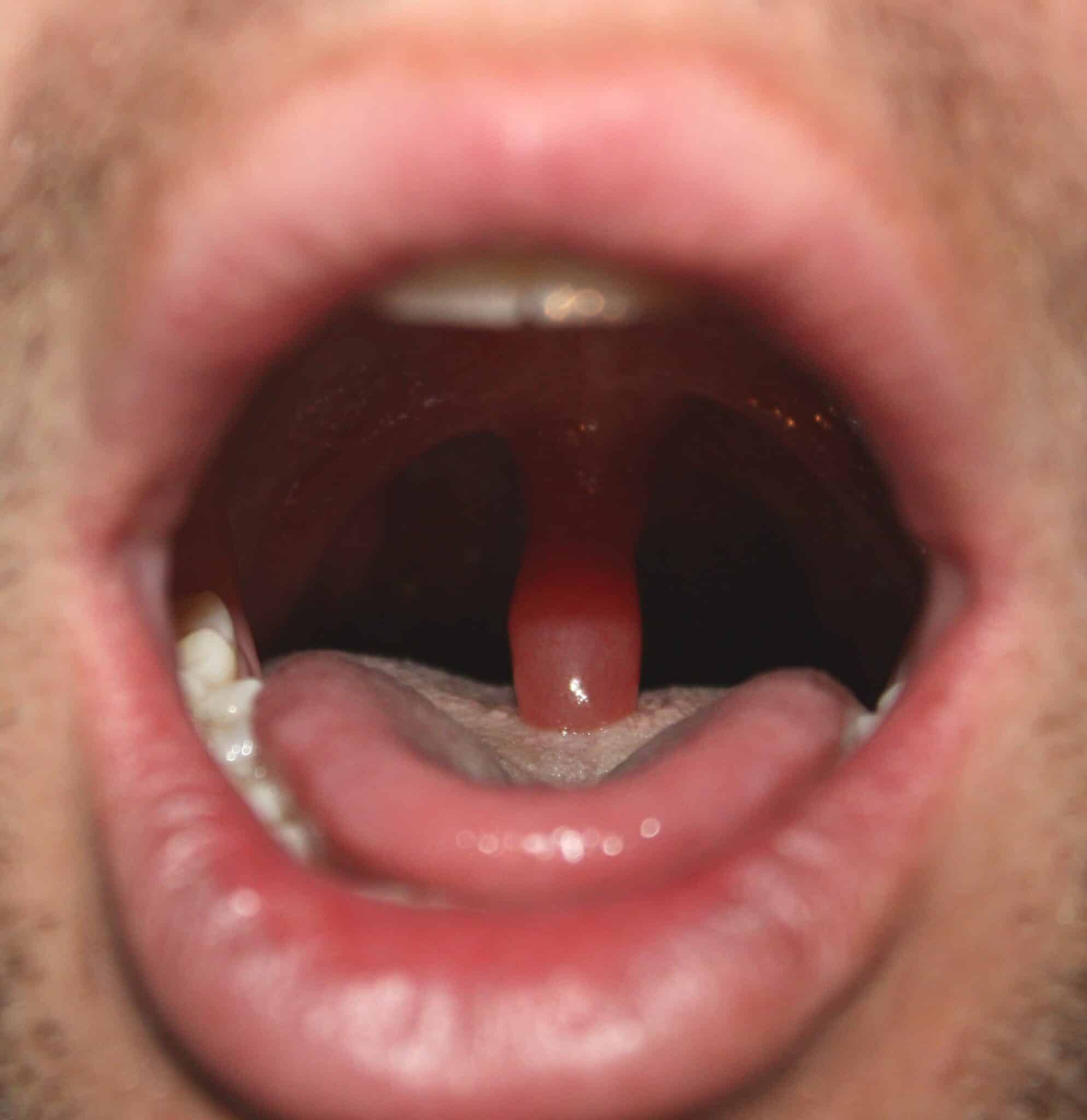 How Long Swollen Uvula After Tonsillectomy And Why