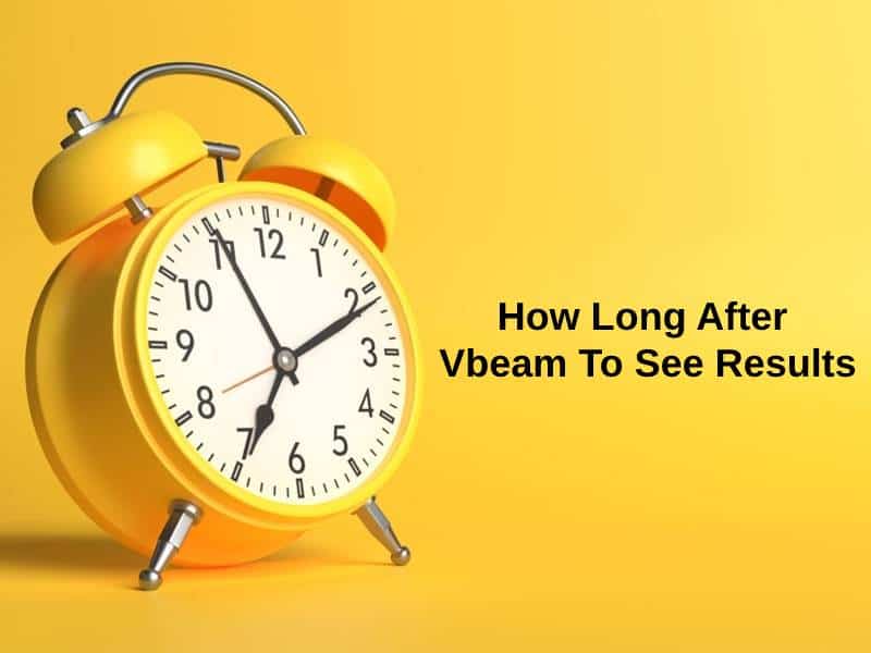 How Long After Vbeam To See Results