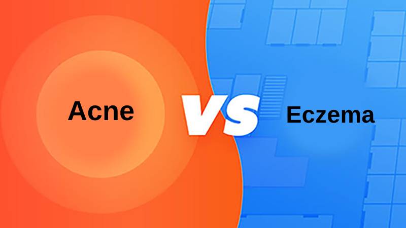 Diferença entre acne e eczema