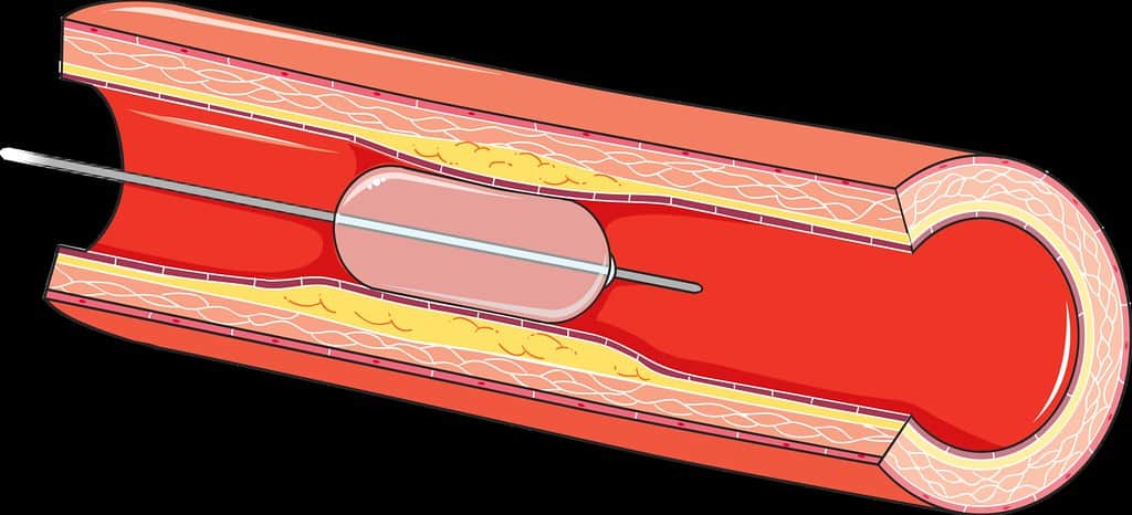 Angioplasty