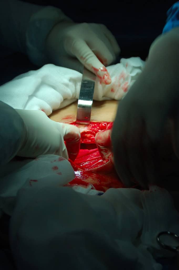 Cesarean