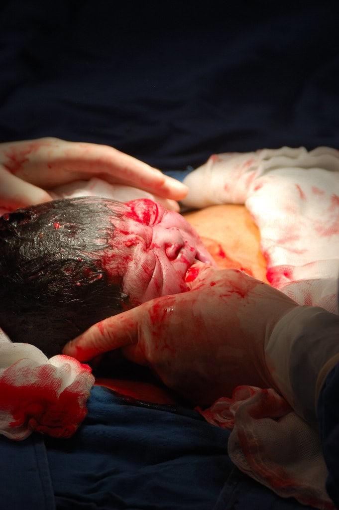 Cesarean