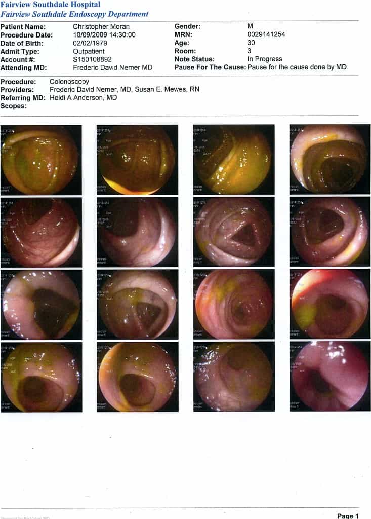 Colonoscopy