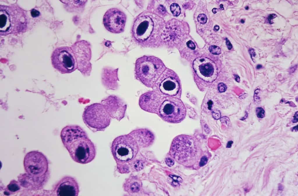 Cytomegalovirus