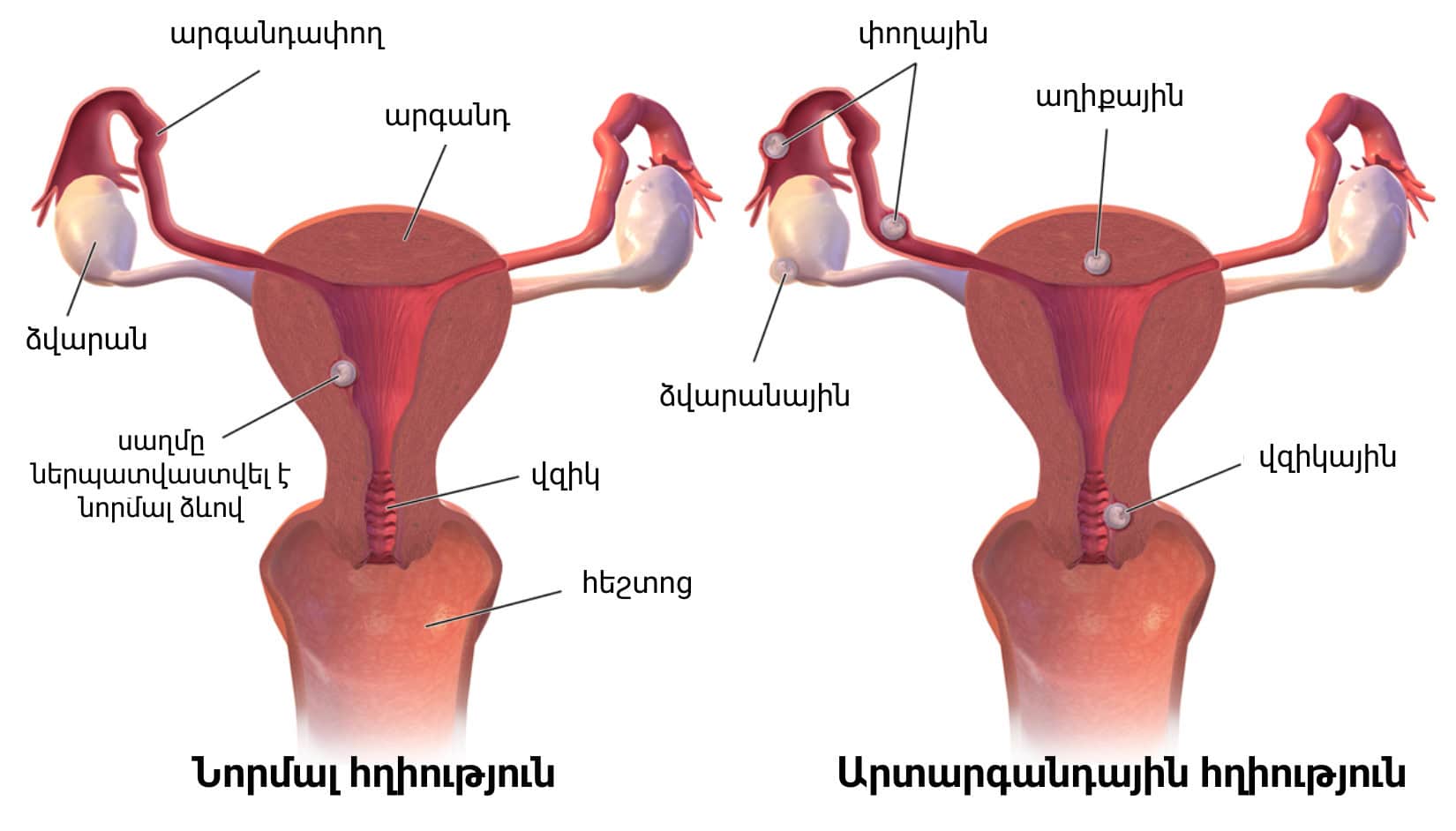 Ectopic Pregnancy