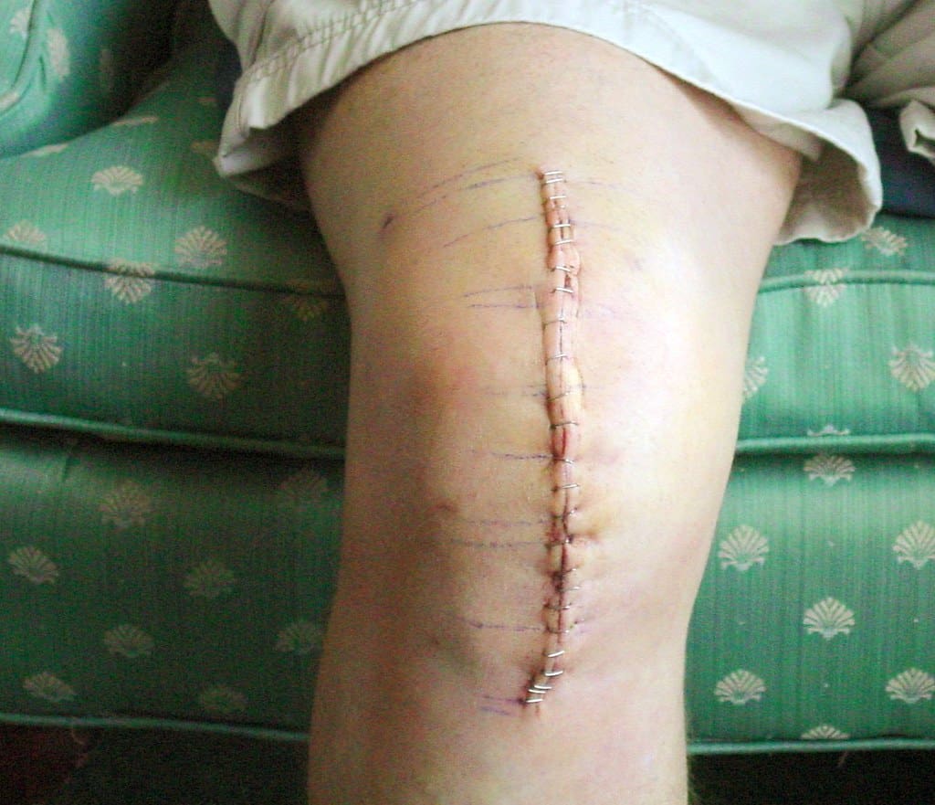 Knee Replacement