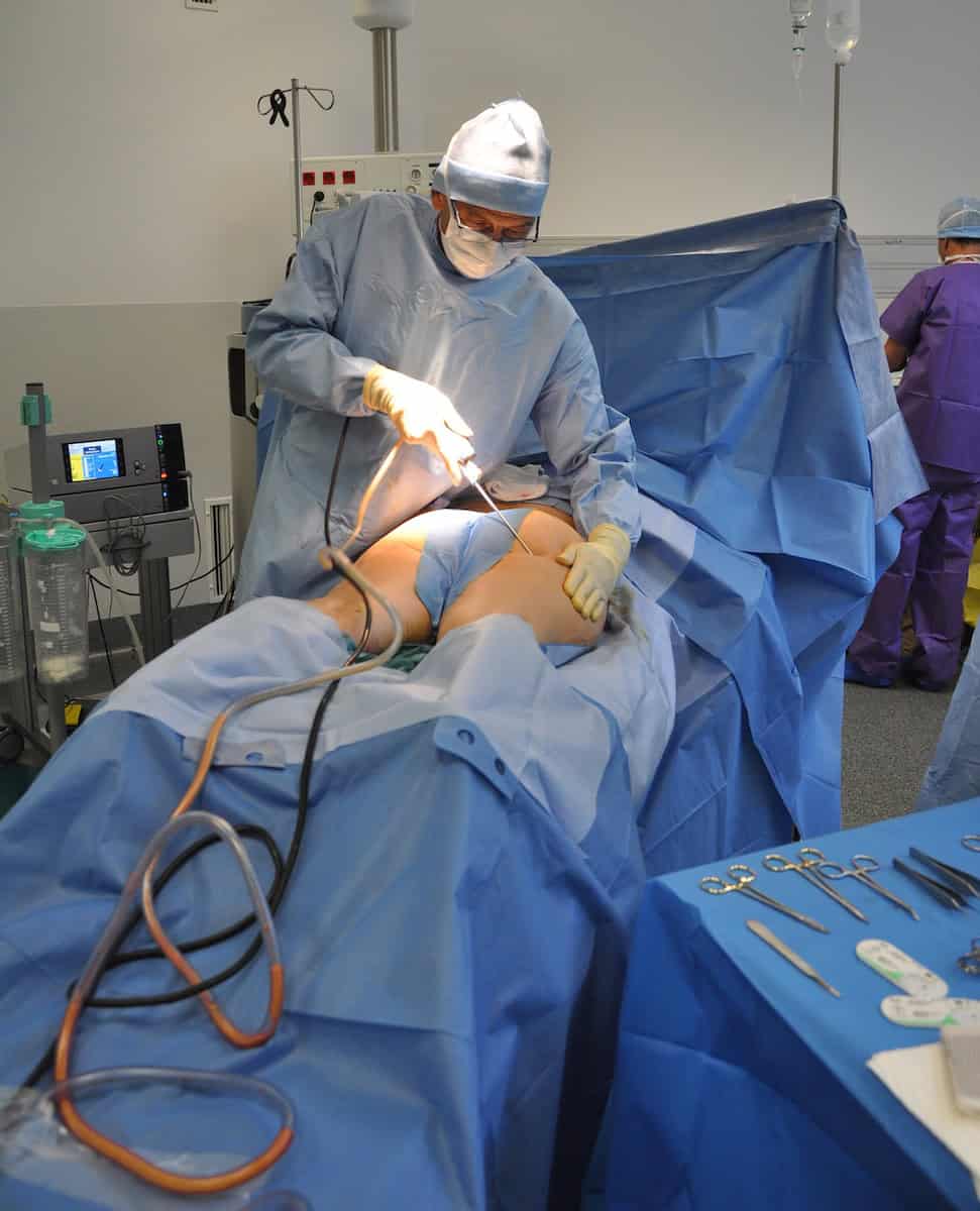 liposuction