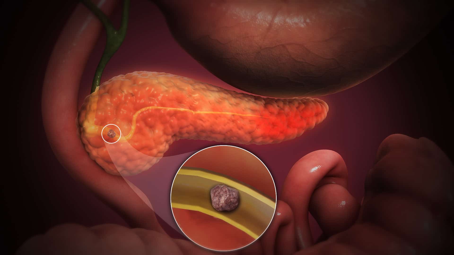 How Long After ERCP Can Pancreatitis Develop (And Why)?