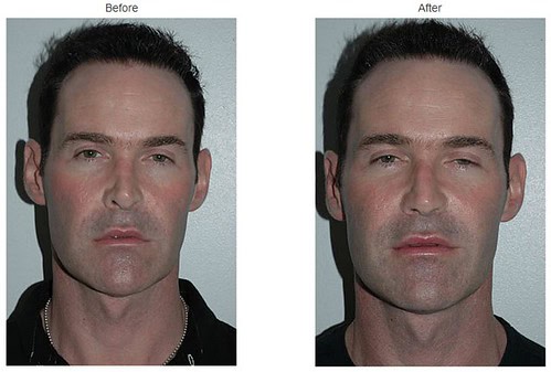 Rhinoplasty