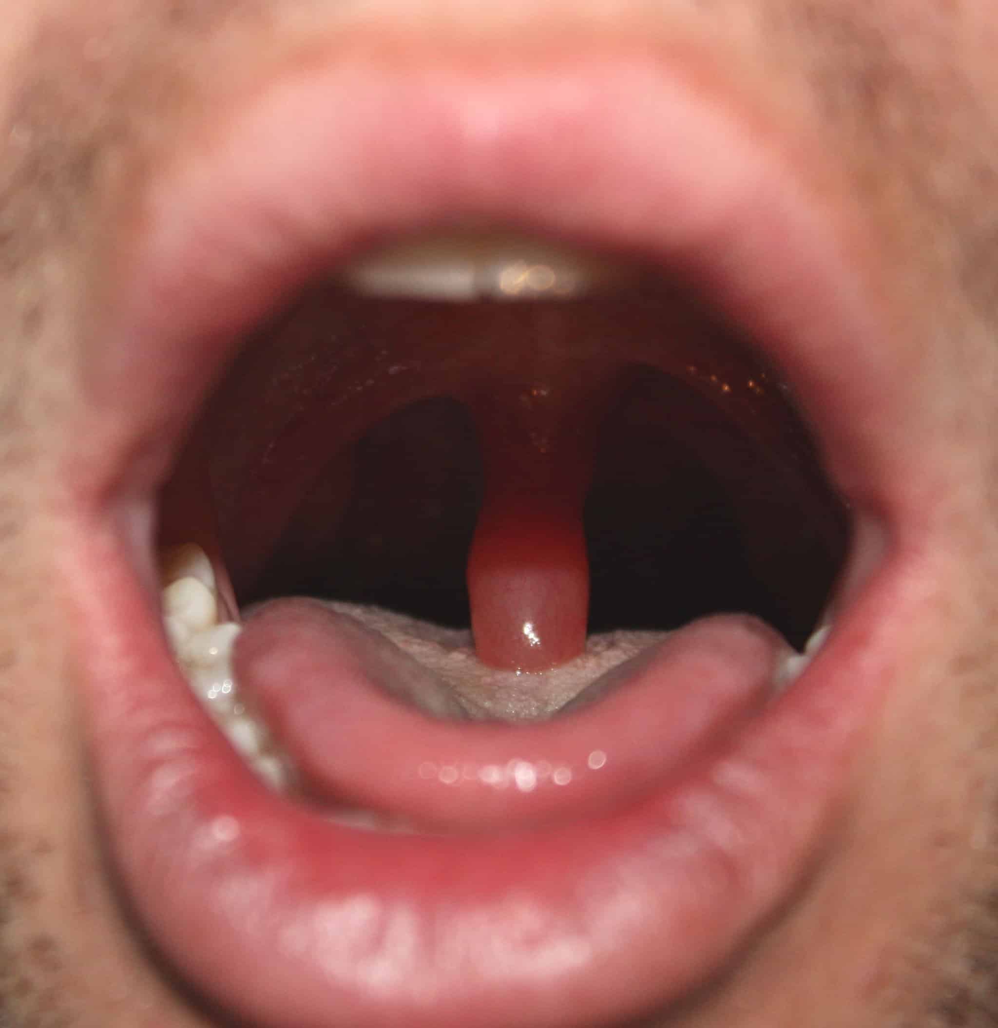 How Long Swollen Uvula After Tonsillectomy And Why