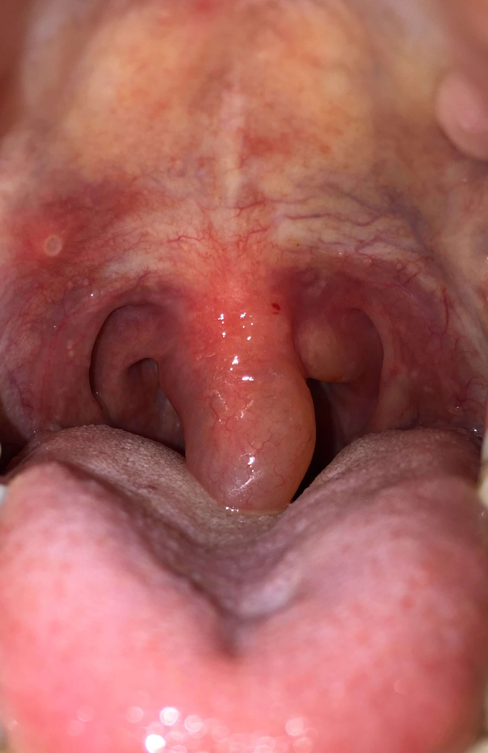 Swollen Uvula