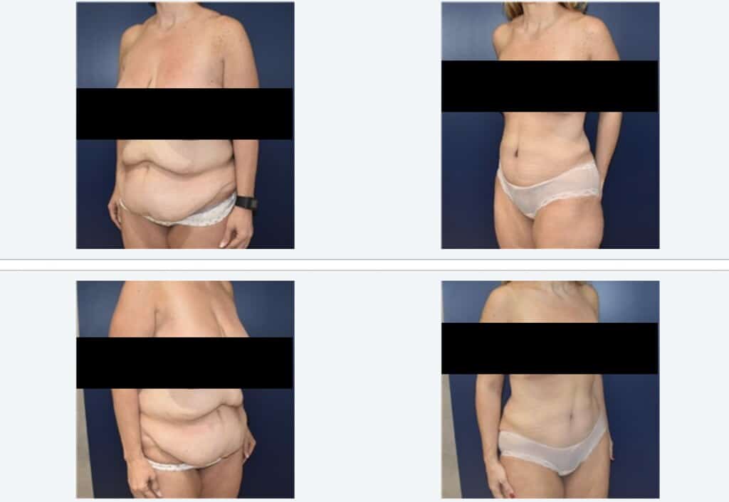 Tummy Tuck